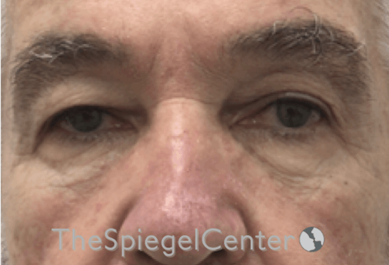 Blepharoplasty Before & After Gallery - Patient 177269766 - Image 3