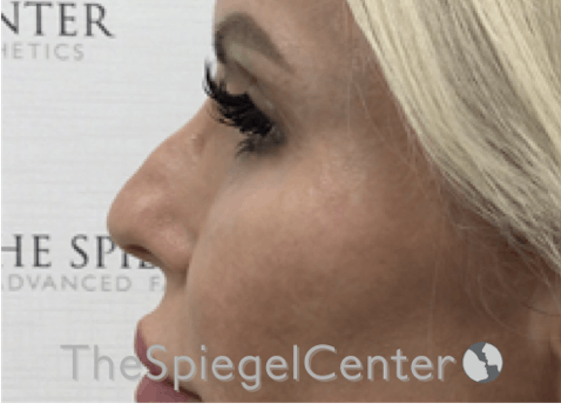 Non-Surgical Rhinoplasty / Nose Filler Before & After Gallery - Patient 177269769 - Image 3