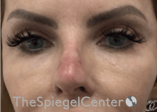 Non-Surgical Rhinoplasty / Nose Filler Before & After Gallery - Patient 177269769 - Image 2