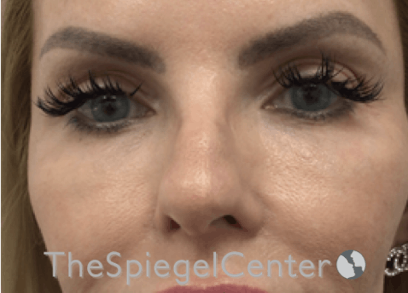 Non-Surgical Rhinoplasty / Nose Filler Before & After Gallery - Patient 177269769 - Image 1