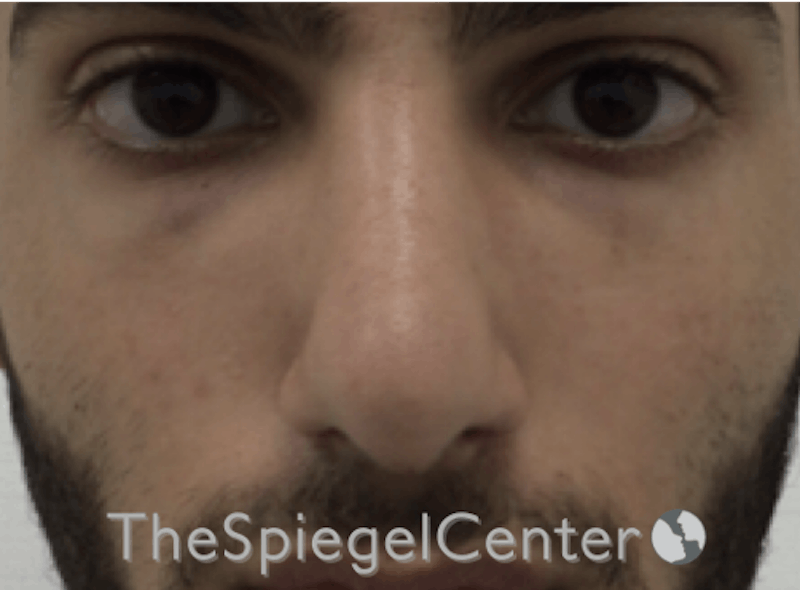 Rhinoplasty Before & After Gallery - Patient 169935851 - Image 4