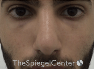 Rhinoplasty Before & After Gallery - Patient 169935851 - Image 4