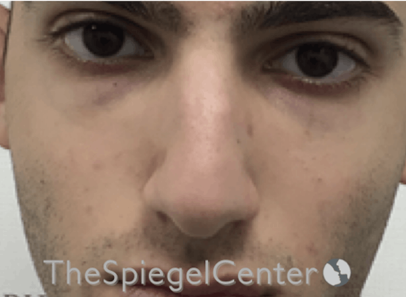 Rhinoplasty Before & After Gallery - Patient 169935851 - Image 3