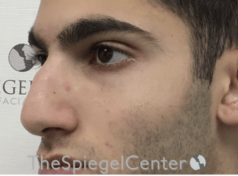 Rhinoplasty