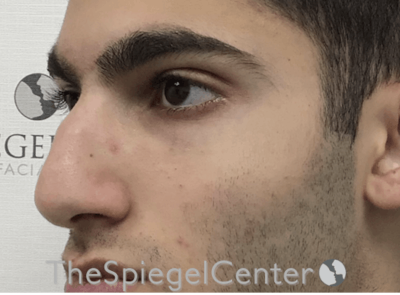 Rhinoplasty Before & After Gallery - Patient 169935851 - Image 1