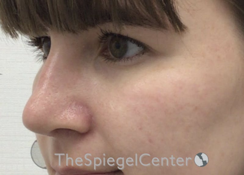 Rhinoplasty Before & After Gallery - Patient 169935852 - Image 2