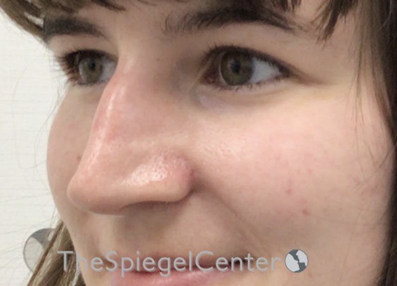 Rhinoplasty Before & After Gallery - Patient 169935852 - Image 1