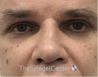 Rhinoplasty Before & After Gallery - Patient 179445211 - Image 4