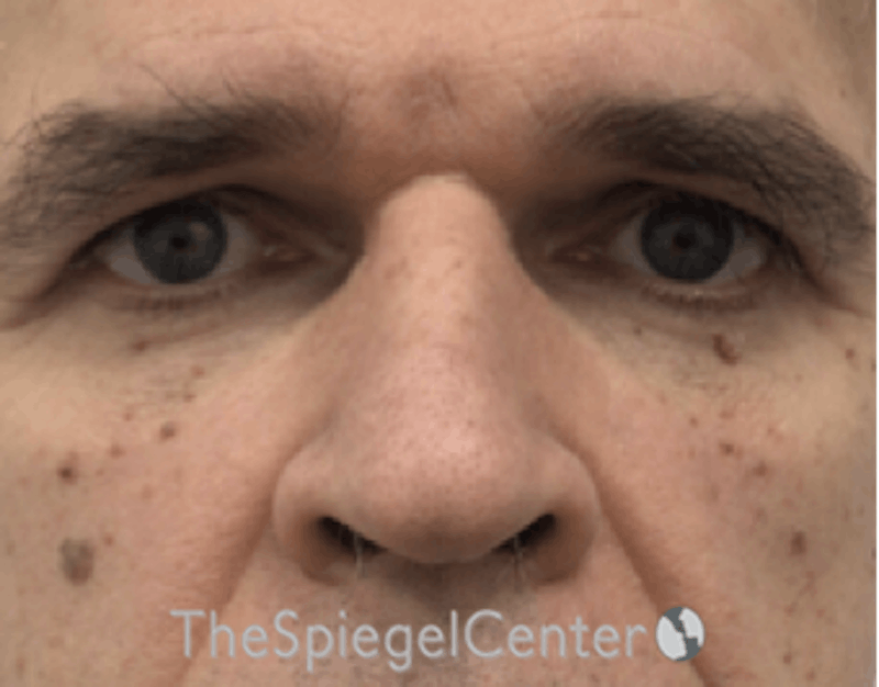 Rhinoplasty Before & After Gallery - Patient 179445211 - Image 3