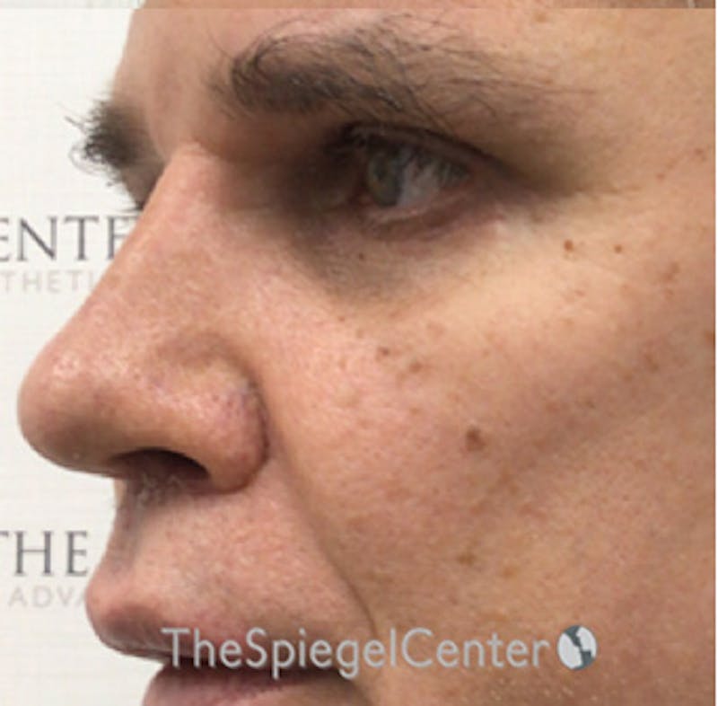 Rhinoplasty Before & After Gallery - Patient 179445211 - Image 2