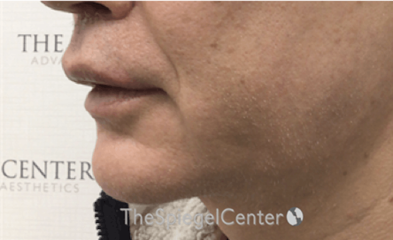 Mandible Contouring Before & After Gallery - Patient 179445216 - Image 4