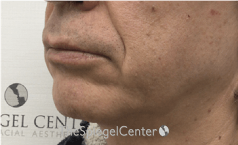 Mandible Contouring Before & After Gallery - Patient 179445216 - Image 3