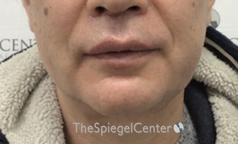 Mandible Contouring Before & After Gallery - Patient 179445216 - Image 2