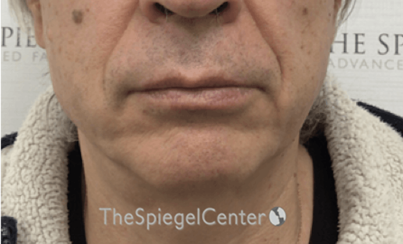 Mandible Contouring Before & After Gallery - Patient 179445216 - Image 1