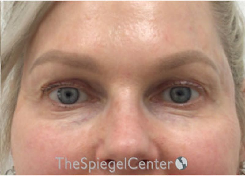 Temple Filler Before & After Gallery - Patient 181802573 - Image 2