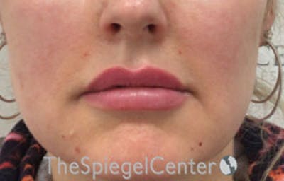 Nasolabial Fold Filler Before & After Gallery - Patient 181823098 - Image 2