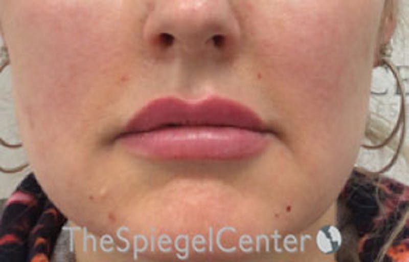 Nasolabial Fold Filler Before & After Gallery - Patient 181823098 - Image 2