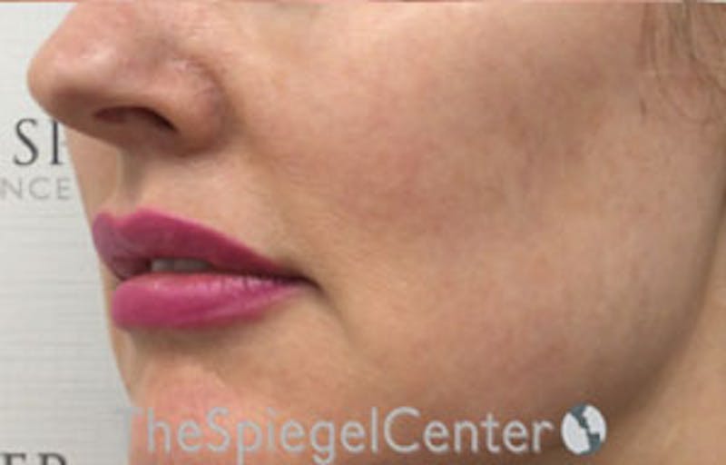 Nasolabial Fold Filler Before & After Gallery - Patient 181823098 - Image 3