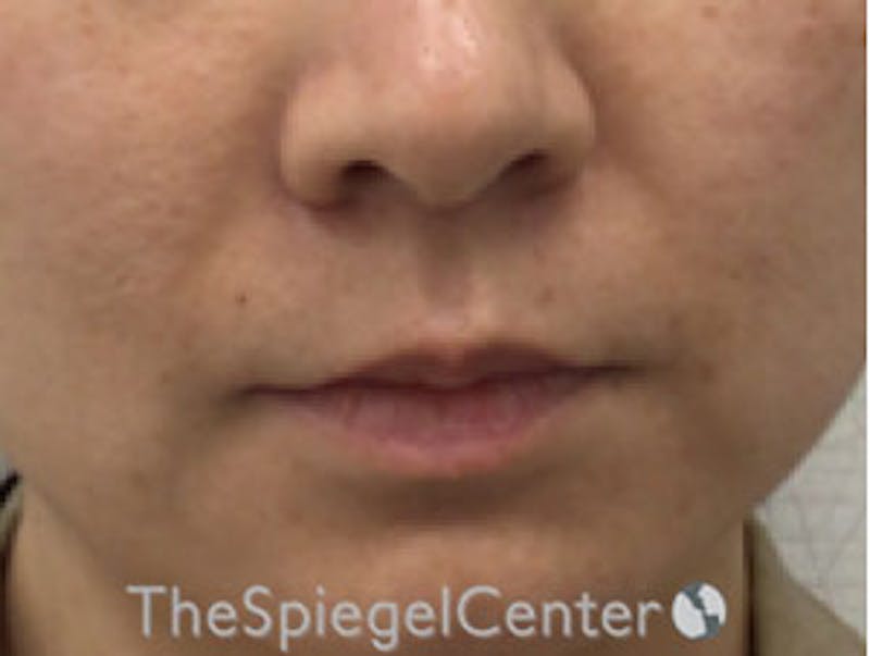 Lip Lift Before & After Gallery - Patient 181823121 - Image 1