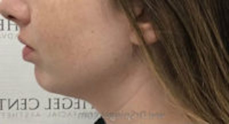 Chin Augmentation Before & After Gallery - Patient 157139832 - Image 5