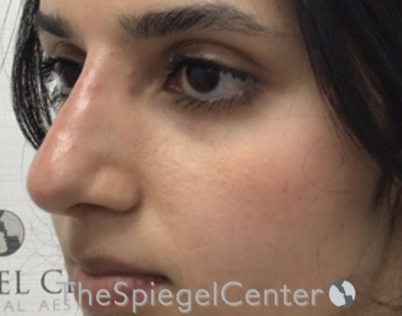 Non-Surgical Rhinoplasty / Nose Filler Before & After Gallery - Patient 185847663 - Image 4