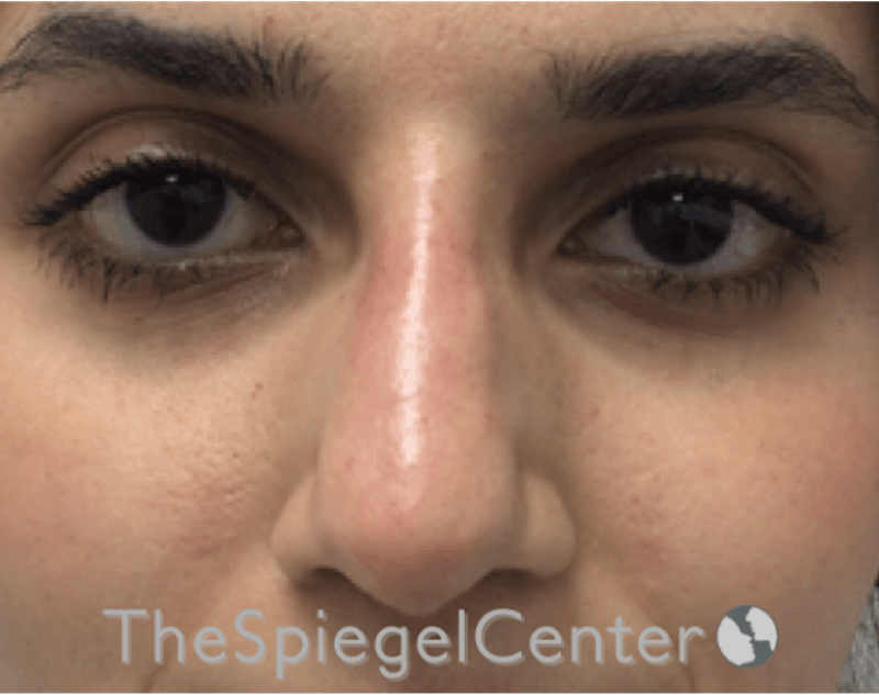 Non-Surgical Rhinoplasty / Nose Filler Before & After Gallery - Patient 185847663 - Image 2