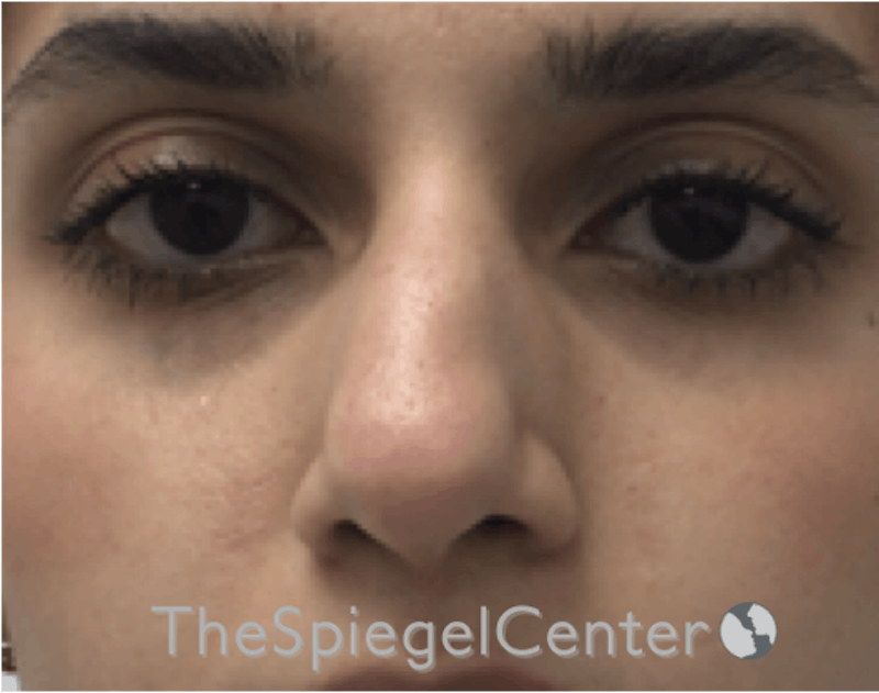Non-Surgical Rhinoplasty / Nose Filler Before & After Gallery - Patient 185847663 - Image 1