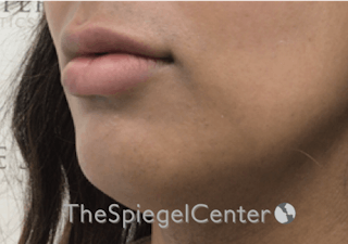 Lip Filler Before & After Gallery - Patient 185848768 - Image 6
