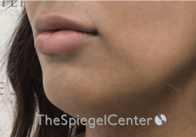 Lip Filler Before & After Gallery - Patient 185848768 - Image 6