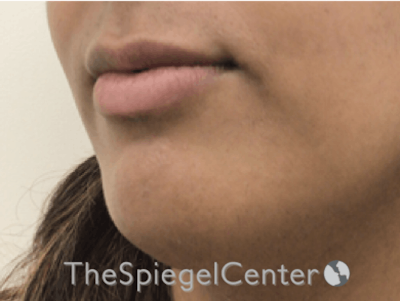 Lip Filler Before & After Gallery - Patient 185848768 - Image 1