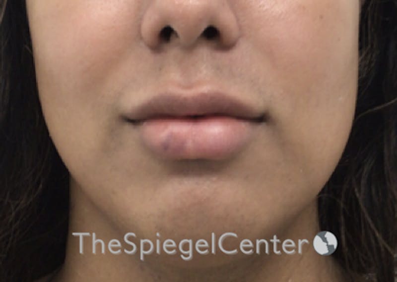 Lip Filler Before & After Gallery - Patient 185848768 - Image 4