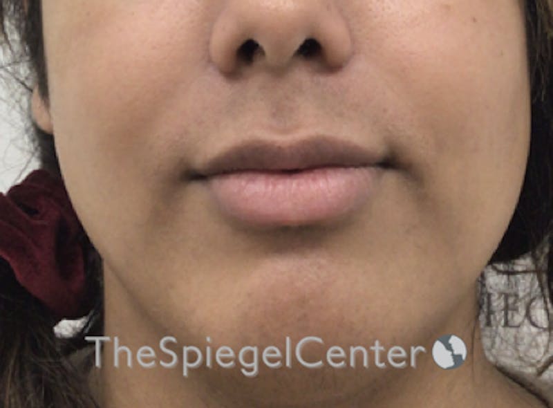 Lip Filler Before & After Gallery - Patient 185848768 - Image 3