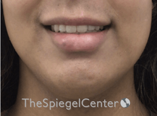 Lip Filler Before & After Gallery - Patient 185848768 - Image 2