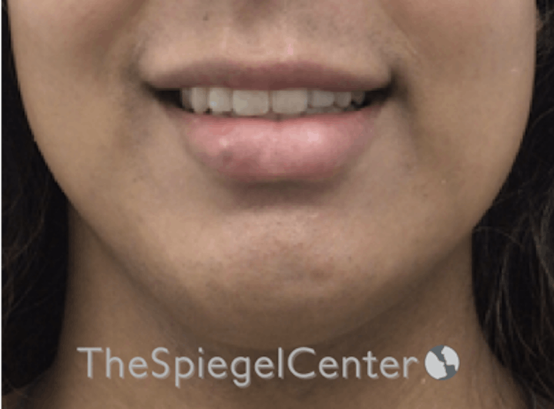 Lip Filler Before & After Gallery - Patient 185848768 - Image 6