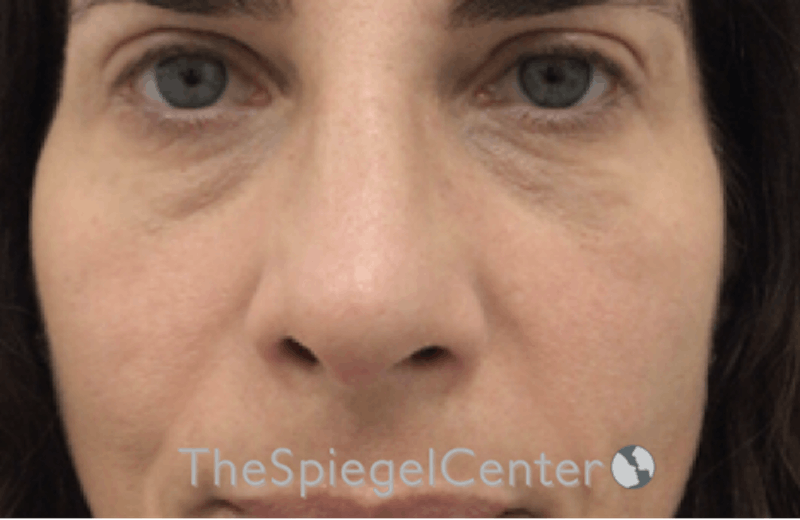Revision Rhinoplasty Before & After Gallery - Patient 185848783 - Image 4