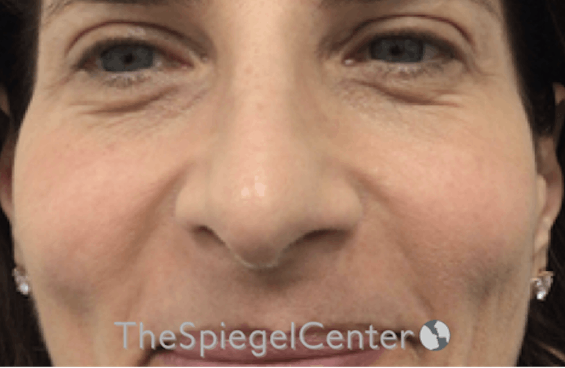 Revision Rhinoplasty Before & After Gallery - Patient 185848783 - Image 3