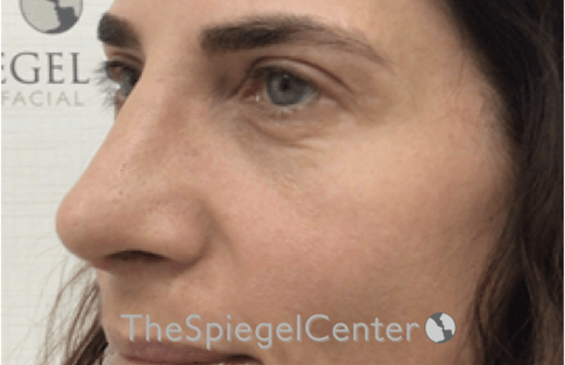 Revision Rhinoplasty Before & After Gallery - Patient 185848783 - Image 2