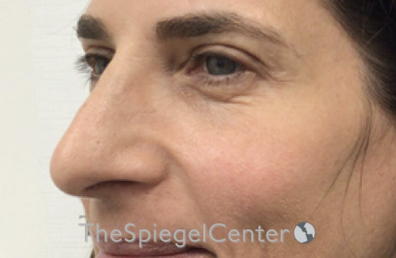 Rhinoplasty Before & After Gallery - Patient 185848772 - Image 1