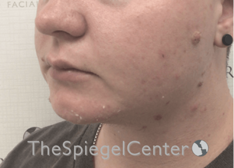 Chin Filler Before & After Gallery - Patient 185860825 - Image 2