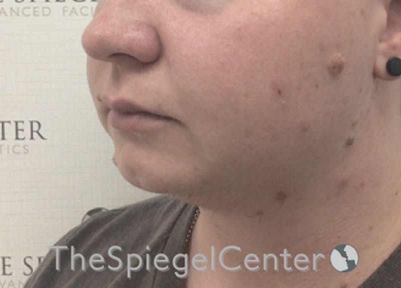 Chin Filler Before & After Gallery - Patient 185860825 - Image 1