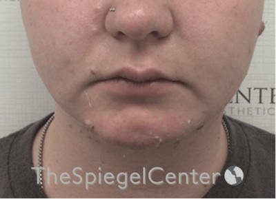 Chin Filler Before & After Gallery - Patient 185860825 - Image 4