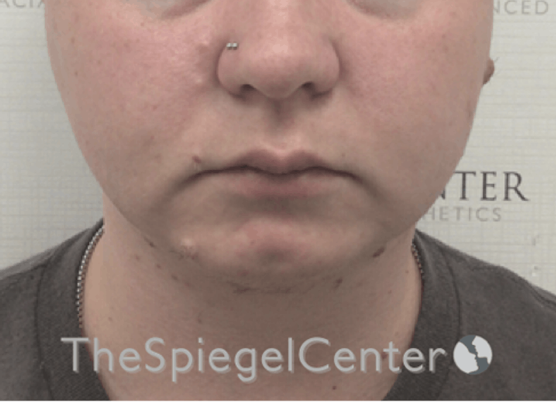 Chin Filler Before & After Gallery - Patient 185860825 - Image 3
