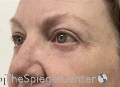 Blepharoplasty Before & After Gallery - Patient 185860877 - Image 4