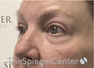Blepharoplasty Before & After Gallery - Patient 185860877 - Image 3
