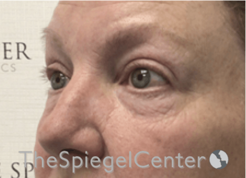 Blepharoplasty Before & After Gallery - Patient 185860877 - Image 3