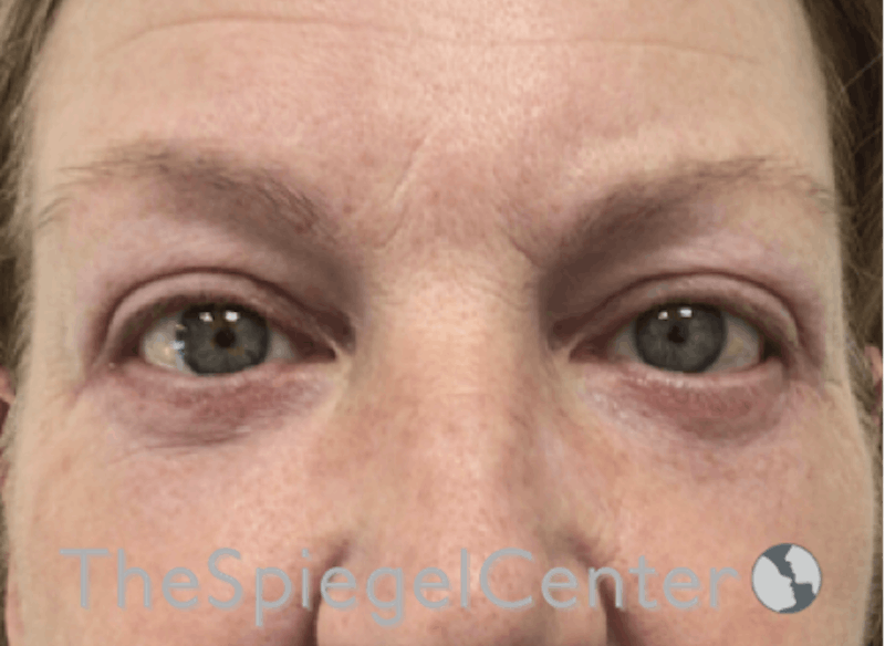 Blepharoplasty Before & After Gallery - Patient 185860877 - Image 2