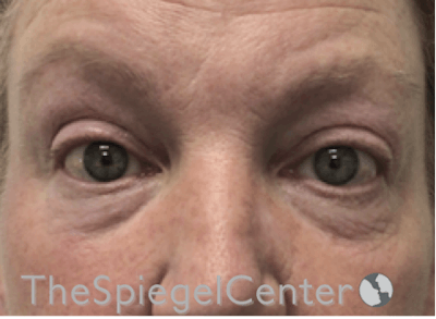 Blepharoplasty Before & After Gallery - Patient 185860877 - Image 1