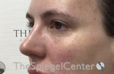 Tear Trough / Under Eye Fillers Before & After Gallery - Patient 185860881 - Image 4