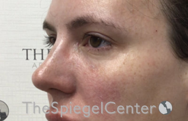 Tear Trough / Under Eye Fillers Before & After Gallery - Patient 185860881 - Image 4