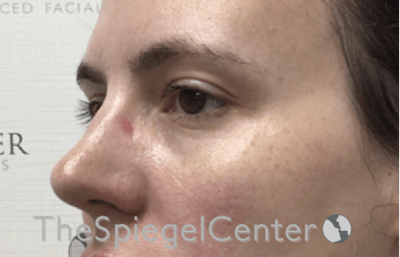 Tear Trough / Under Eye Fillers Before & After Gallery - Patient 185860881 - Image 3